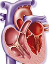 Management of Type II Diabetes and Cardiovascular Disease